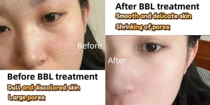 Asian Doll BBL Surgery: Before And After Photos