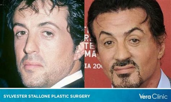 Everything There is to Know About Sylvester Stallones Plastic Surgery