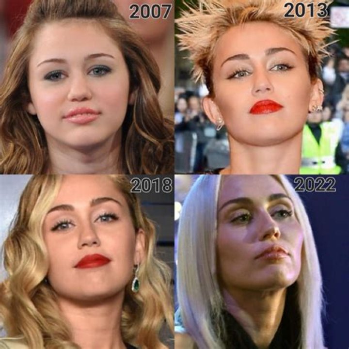 Miley Cyrus Buccal Fat Removal: Before And After Photos